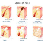 The Acne Files: From A to Zit. In depth acne info, causes, best products and treatment.